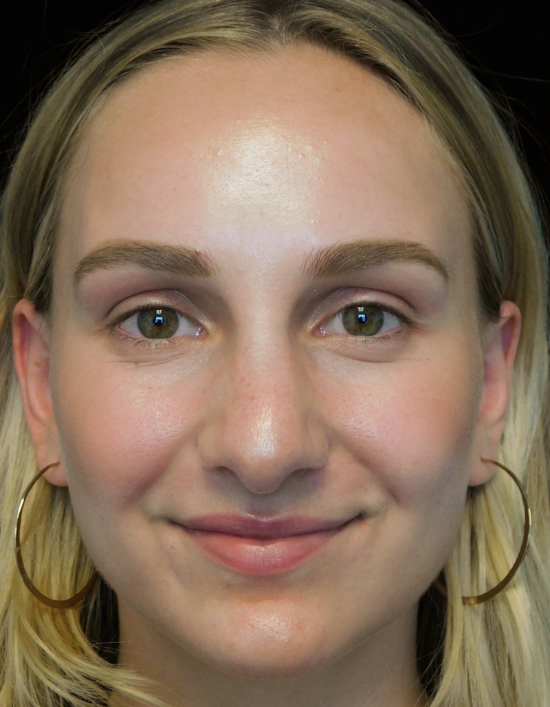 Beverly Hills Rhinoplasty Before & After Gallery - Patient 955593 - Image 5 Dr. Deepak Raj Dugar