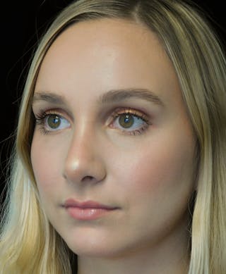 Beverly Hills Rhinoplasty Before & After Gallery - Patient 955593 - Image 8 Dr. Deepak Raj Dugar