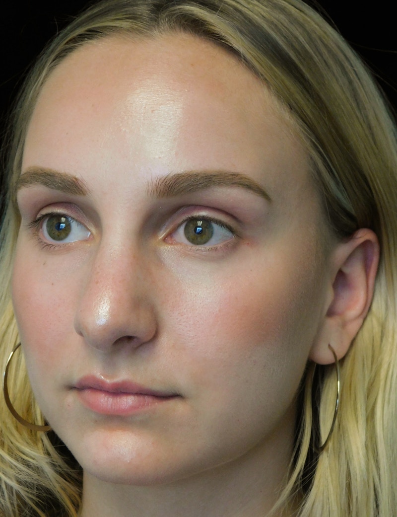 Beverly Hills Rhinoplasty Before & After Gallery - Patient 955593 - Image 7 Dr. Deepak Raj Dugar