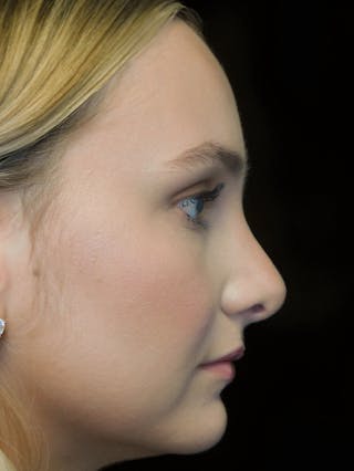 Beverly Hills Rhinoplasty Before & After Gallery - Patient 955593 - Image 2 Dr. Deepak Raj Dugar