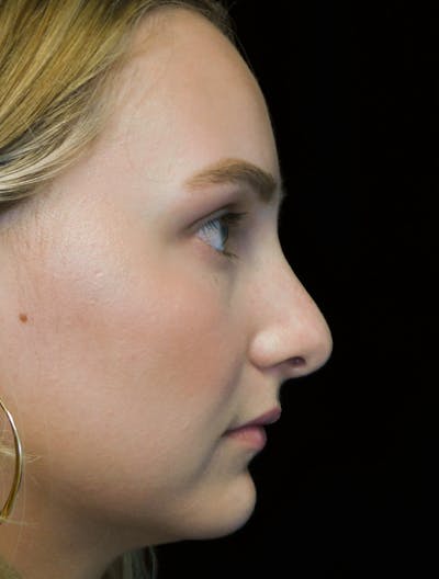 Beverly Hills Rhinoplasty Before & After Gallery - Patient 955593 - Image 1 Dr. Deepak Raj Dugar