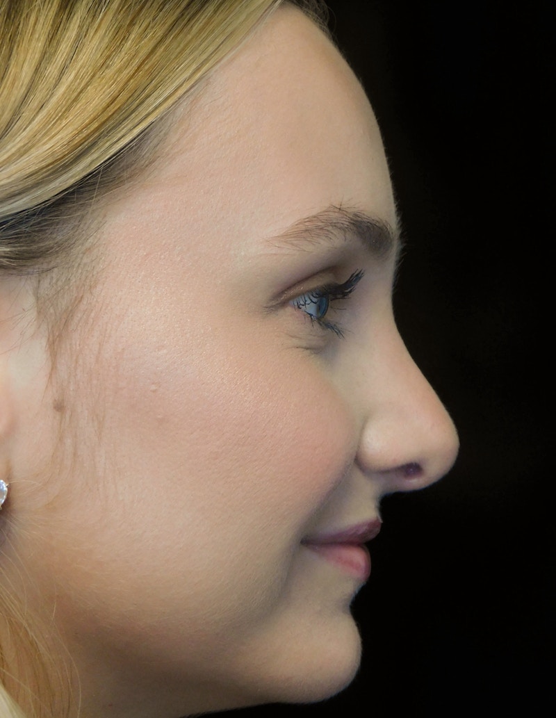 Beverly Hills Rhinoplasty Before & After Gallery - Patient 955593 - Image 10 Dr. Deepak Raj Dugar
