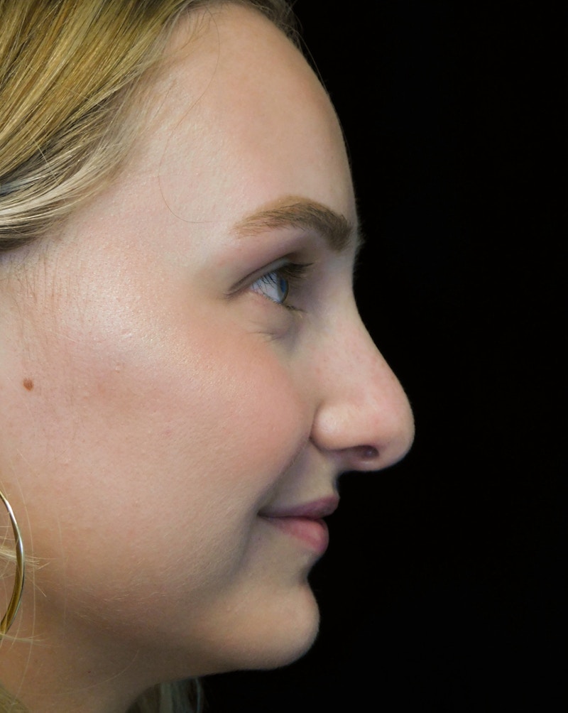 Beverly Hills Rhinoplasty Before & After Gallery - Patient 955593 - Image 9 Dr. Deepak Raj Dugar