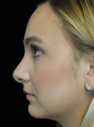 Beverly Hills Rhinoplasty Before & After Gallery - Patient 955593 - Image 12 Dr. Deepak Raj Dugar