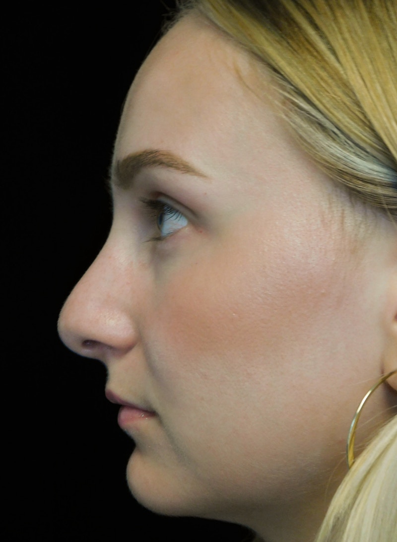Beverly Hills Rhinoplasty Before & After Gallery - Patient 955593 - Image 11 Dr. Deepak Raj Dugar