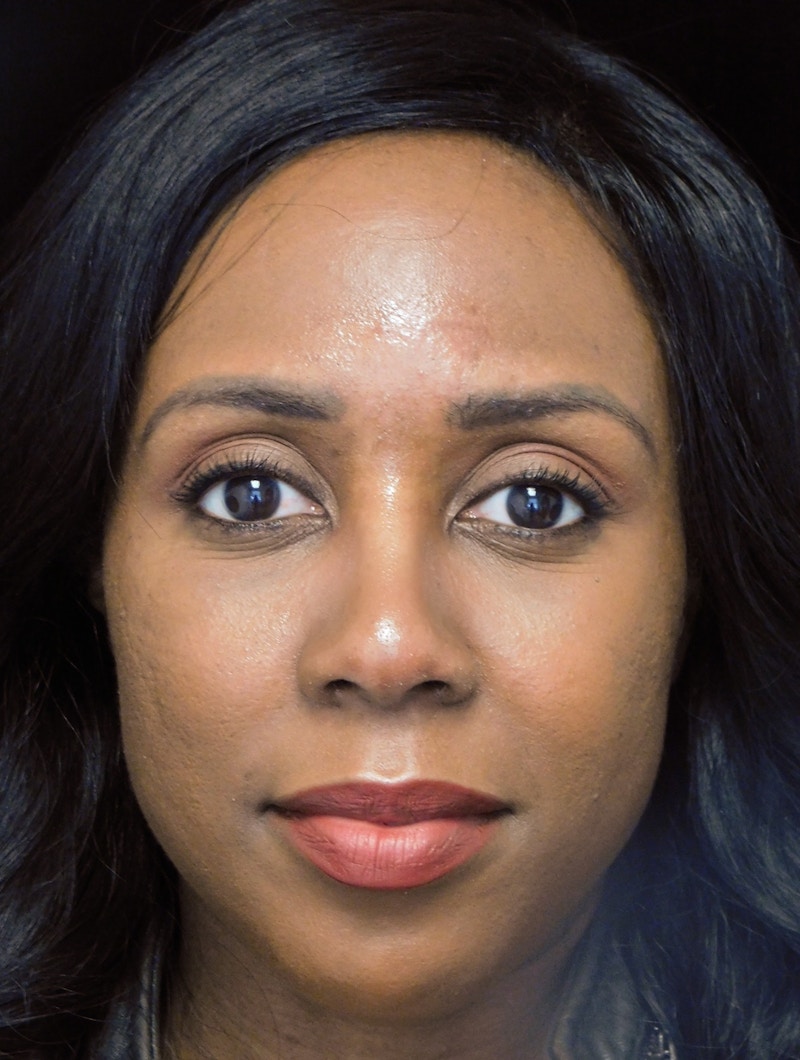 Beverly Hills Rhinoplasty Before & After Gallery - Patient 152084 - Image 4 Dr. Deepak Raj Dugar