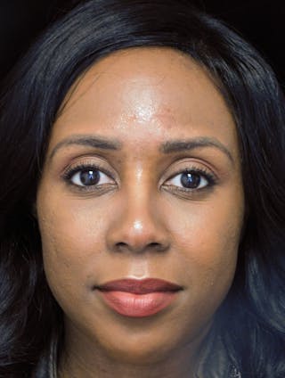 Beverly Hills Rhinoplasty Before & After Gallery - Patient 152084 - Image 4 Dr. Deepak Raj Dugar