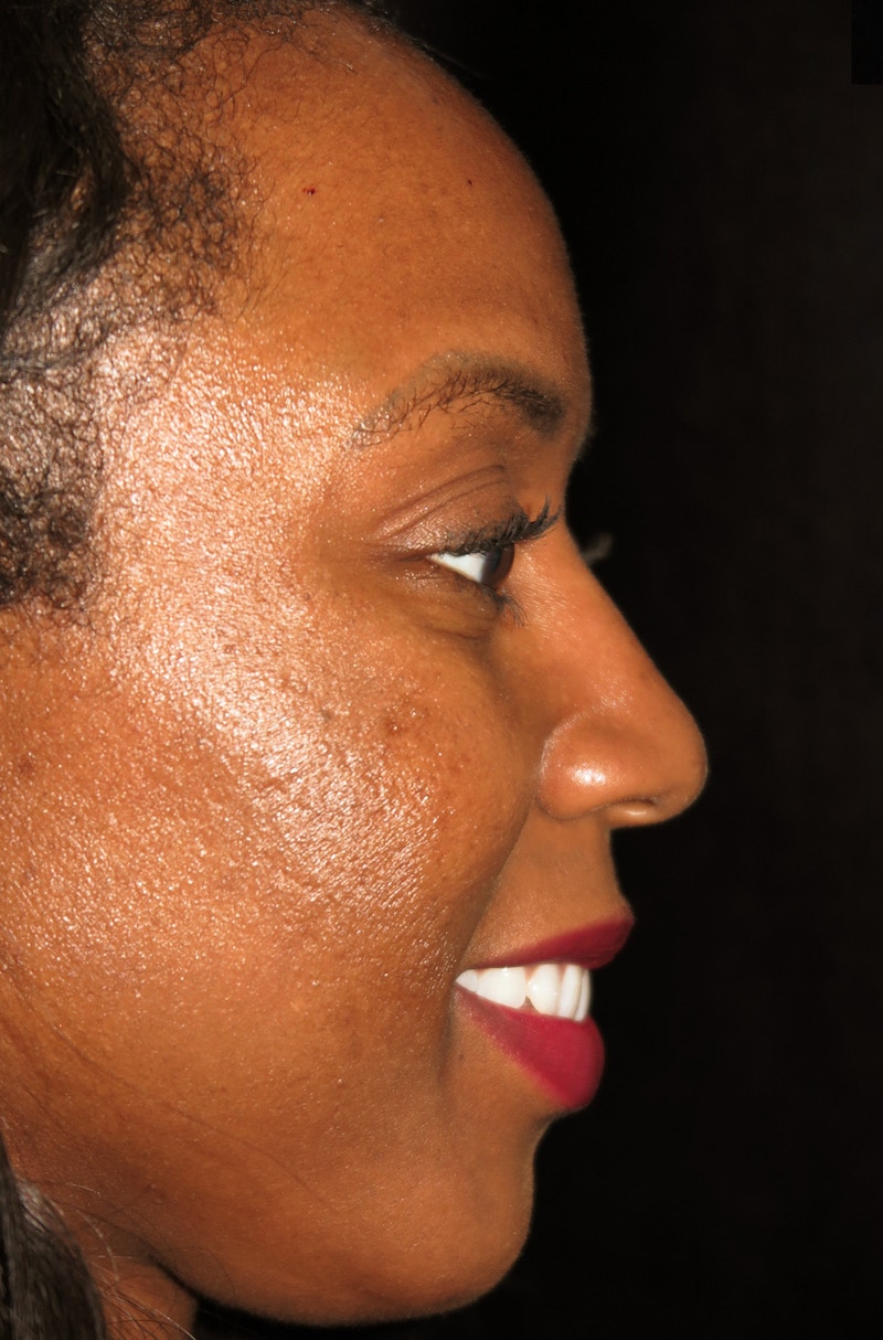 Beverly Hills Rhinoplasty Before & After Gallery - Patient 152084 - Image 1 Dr. Deepak Raj Dugar