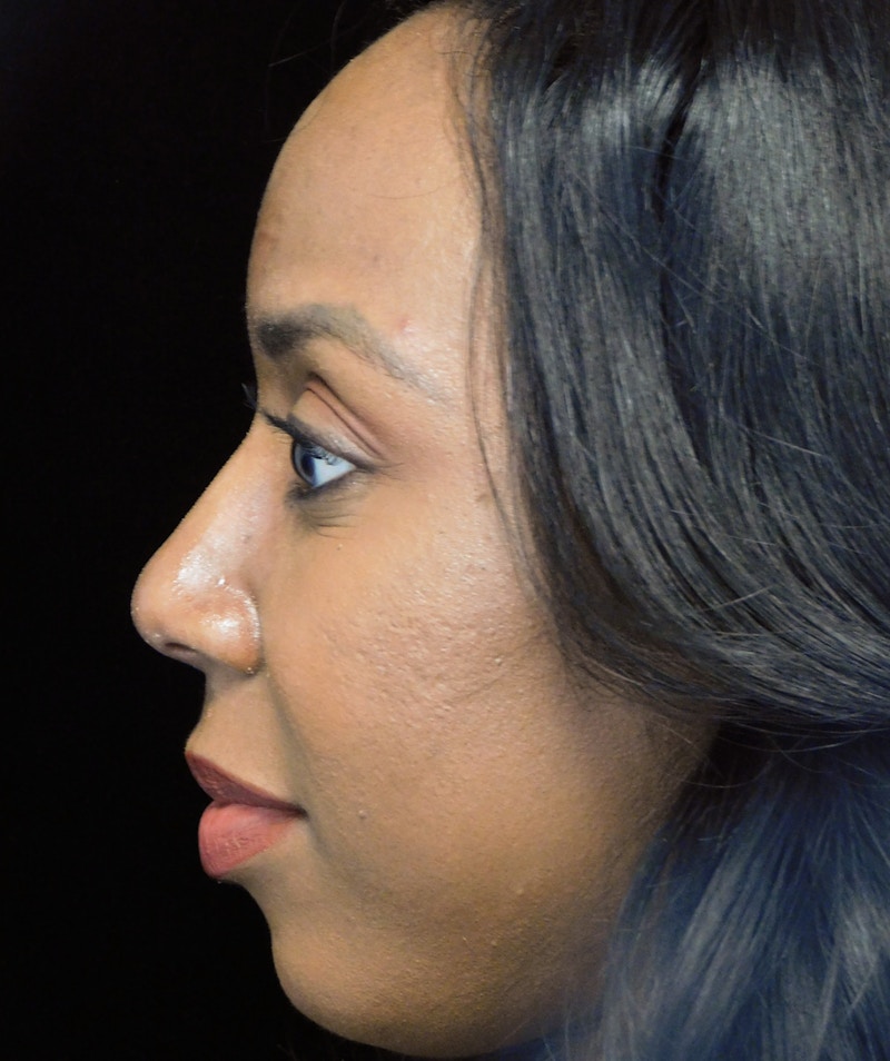 Beverly Hills Rhinoplasty Before & After Gallery - Patient 152084 - Image 10 Dr. Deepak Raj Dugar