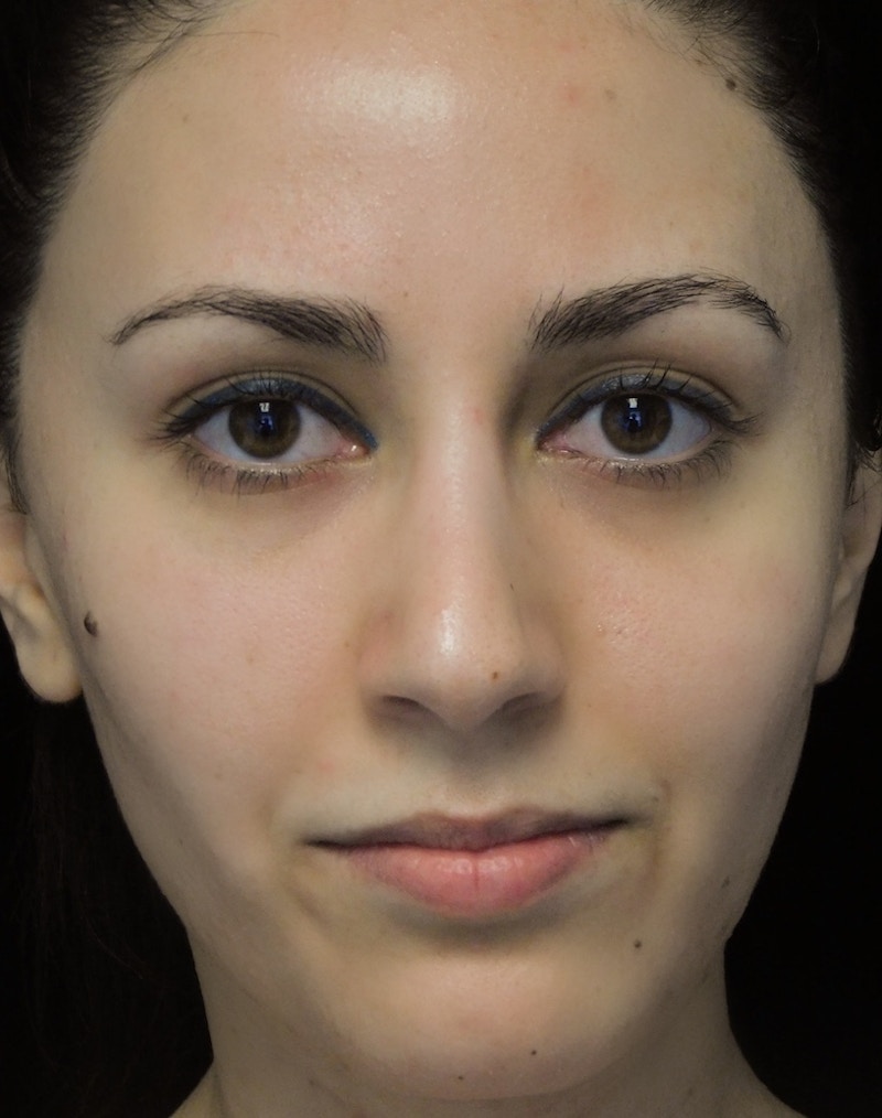 Beverly Hills Rhinoplasty Before & After Gallery - Patient 146540 - Image 4 Dr. Deepak Raj Dugar
