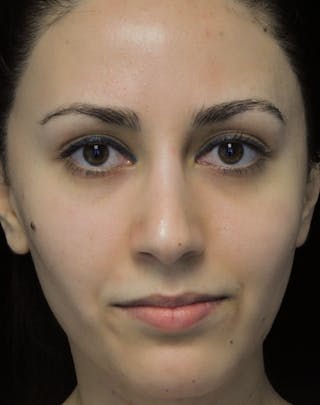 Beverly Hills Rhinoplasty Before & After Gallery - Patient 146540 - Image 4 Dr. Deepak Raj Dugar
