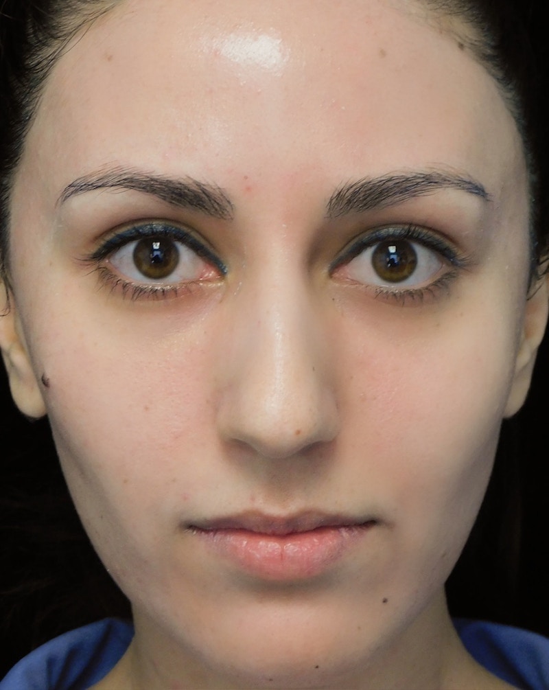 Beverly Hills Rhinoplasty Before & After Gallery - Patient 146540 - Image 3 Dr. Deepak Raj Dugar