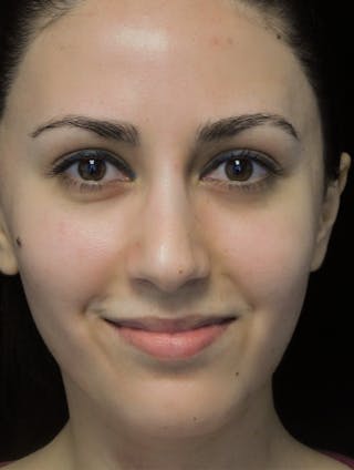 Beverly Hills Rhinoplasty Before & After Gallery - Patient 146540 - Image 6 Dr. Deepak Raj Dugar