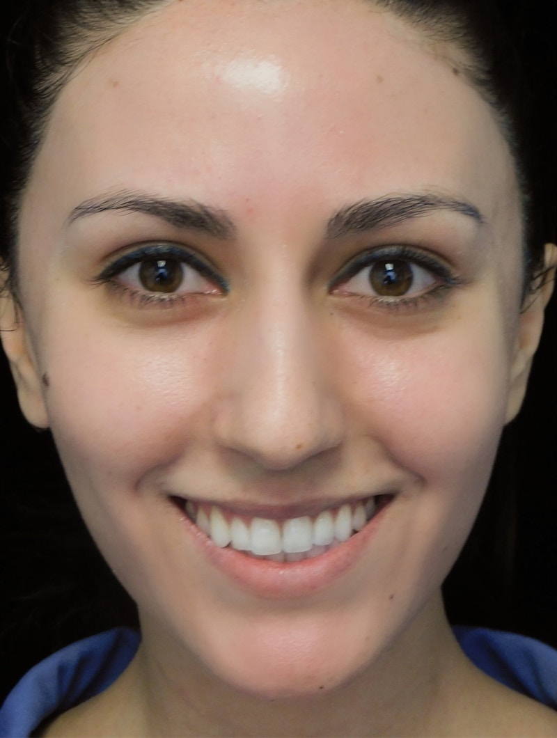 Beverly Hills Rhinoplasty Before & After Gallery - Patient 146540 - Image 5 Dr. Deepak Raj Dugar