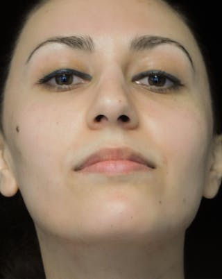Beverly Hills Rhinoplasty Before & After Gallery - Patient 146540 - Image 8 Dr. Deepak Raj Dugar