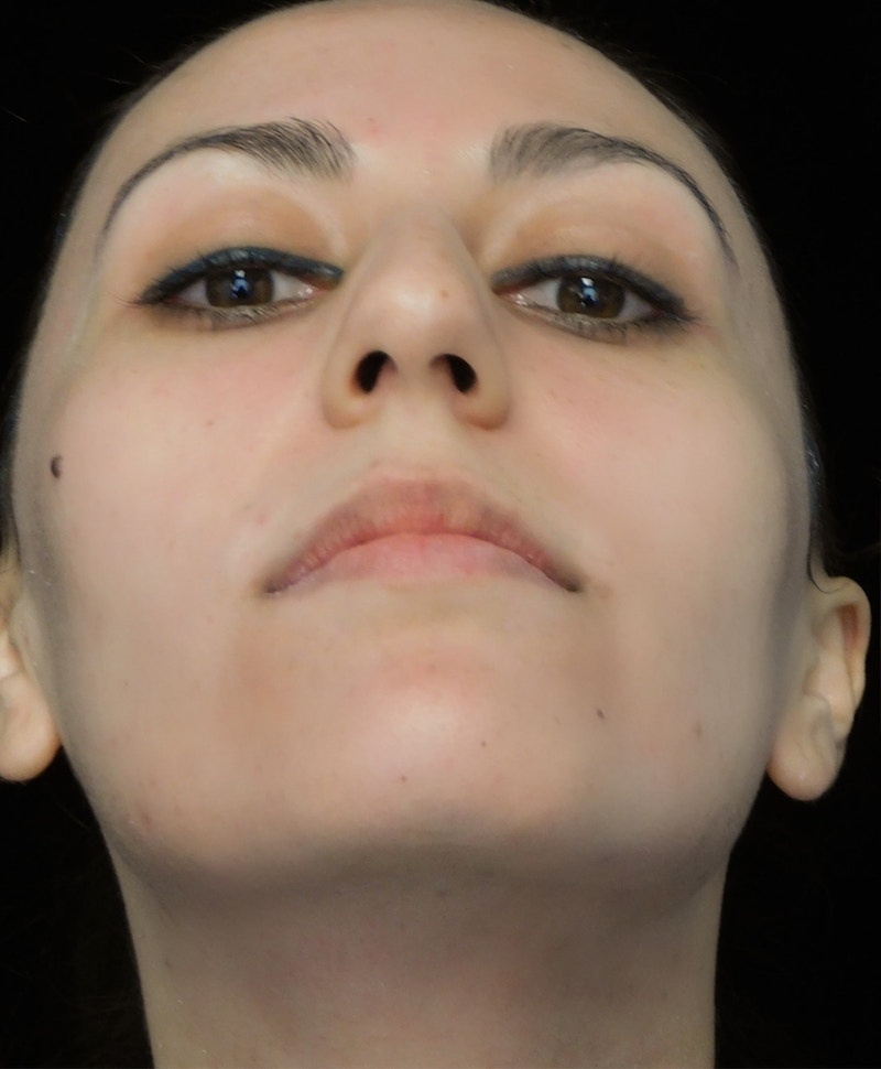 Beverly Hills Rhinoplasty Before & After Gallery - Patient 146540 - Image 7 Dr. Deepak Raj Dugar