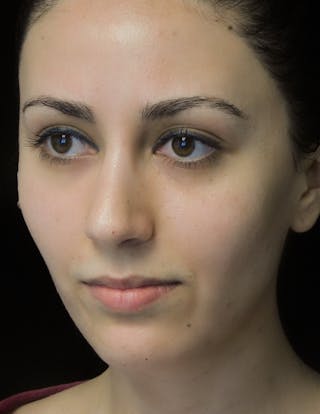 Beverly Hills Rhinoplasty Before & After Gallery - Patient 146540 - Image 10 Dr. Deepak Raj Dugar