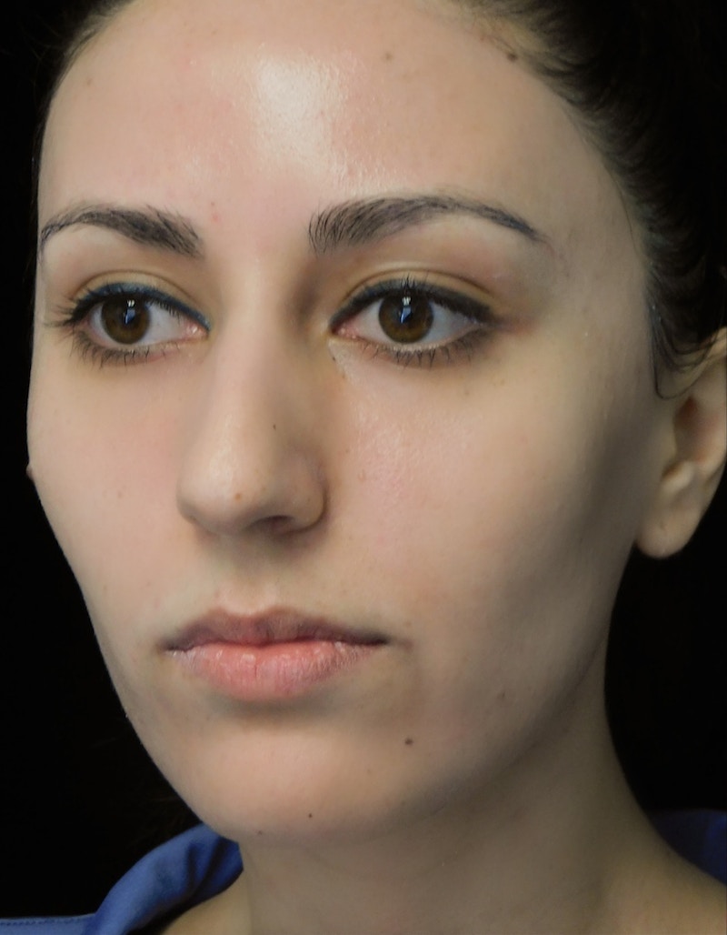 Beverly Hills Rhinoplasty Before & After Gallery - Patient 146540 - Image 9 Dr. Deepak Raj Dugar