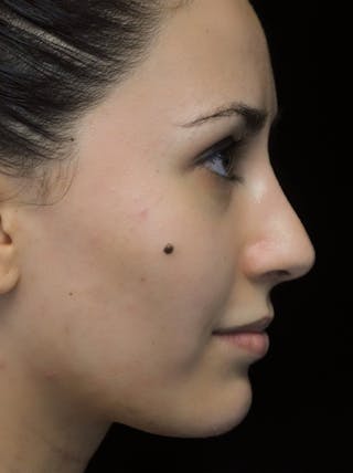 Beverly Hills Rhinoplasty Before & After Gallery - Patient 146540 - Image 2 Dr. Deepak Raj Dugar