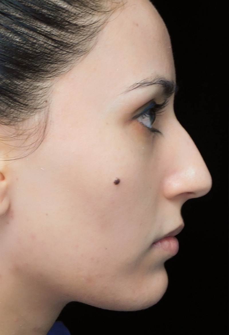 Beverly Hills Rhinoplasty Before & After Gallery - Patient 146540 - Image 1 Dr. Deepak Raj Dugar