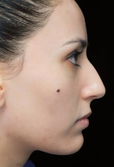 Beverly Hills Rhinoplasty Before & After Gallery - Patient 146540 - Image 1 Dr. Deepak Raj Dugar