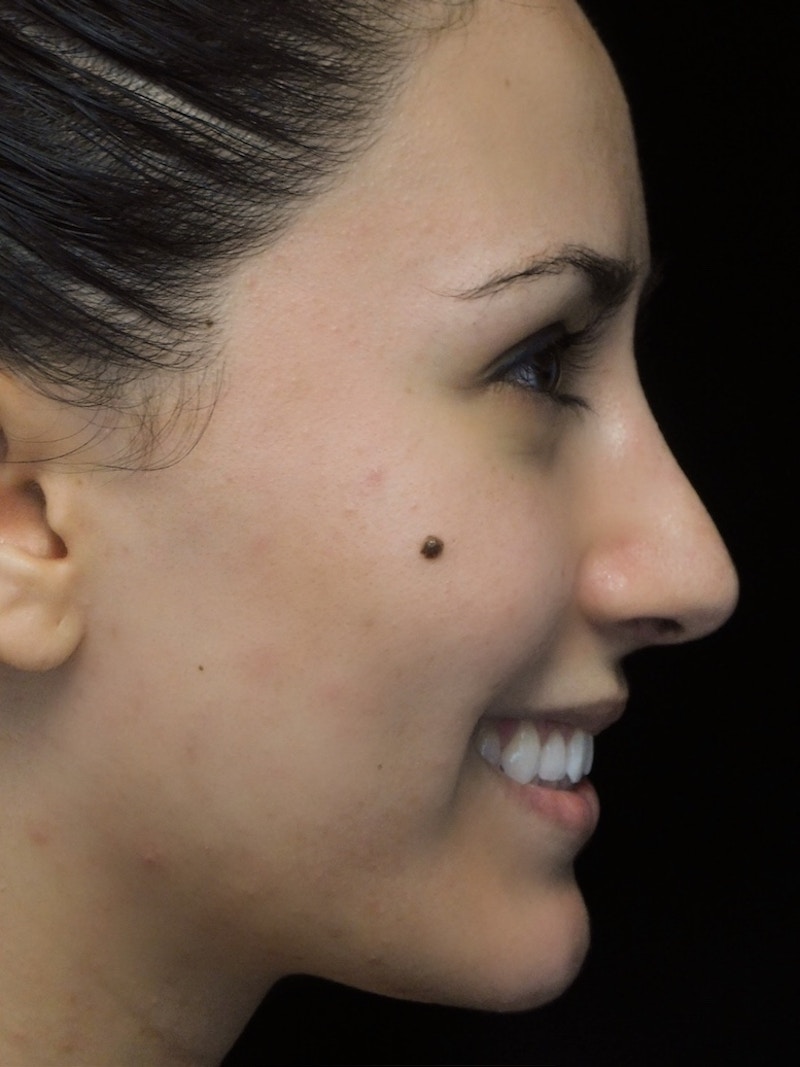 Beverly Hills Rhinoplasty Before & After Gallery - Patient 146540 - Image 12 Dr. Deepak Raj Dugar