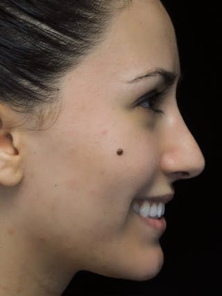 Beverly Hills Rhinoplasty Before & After Gallery - Patient 146540 - Image 12 Dr. Deepak Raj Dugar