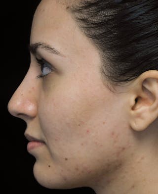 Beverly Hills Rhinoplasty Before & After Gallery - Patient 146540 - Image 14 Dr. Deepak Raj Dugar