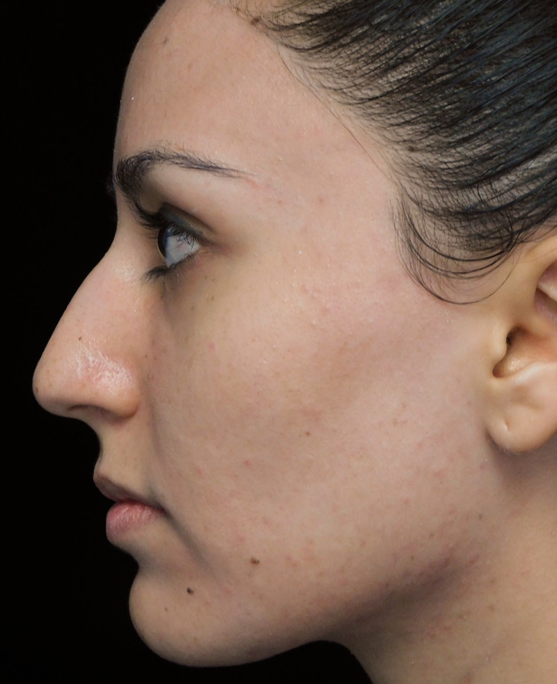 Beverly Hills Rhinoplasty Before & After Gallery - Patient 146540 - Image 13 Dr. Deepak Raj Dugar