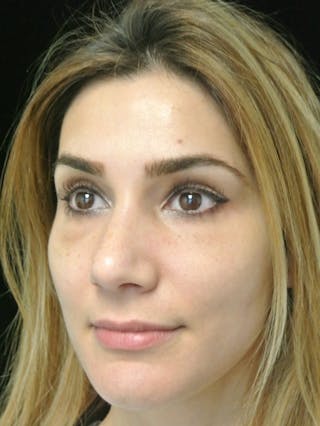 Beverly Hills Rhinoplasty Before & After Gallery - Patient 121795 - Image 4 Dr. Deepak Raj Dugar