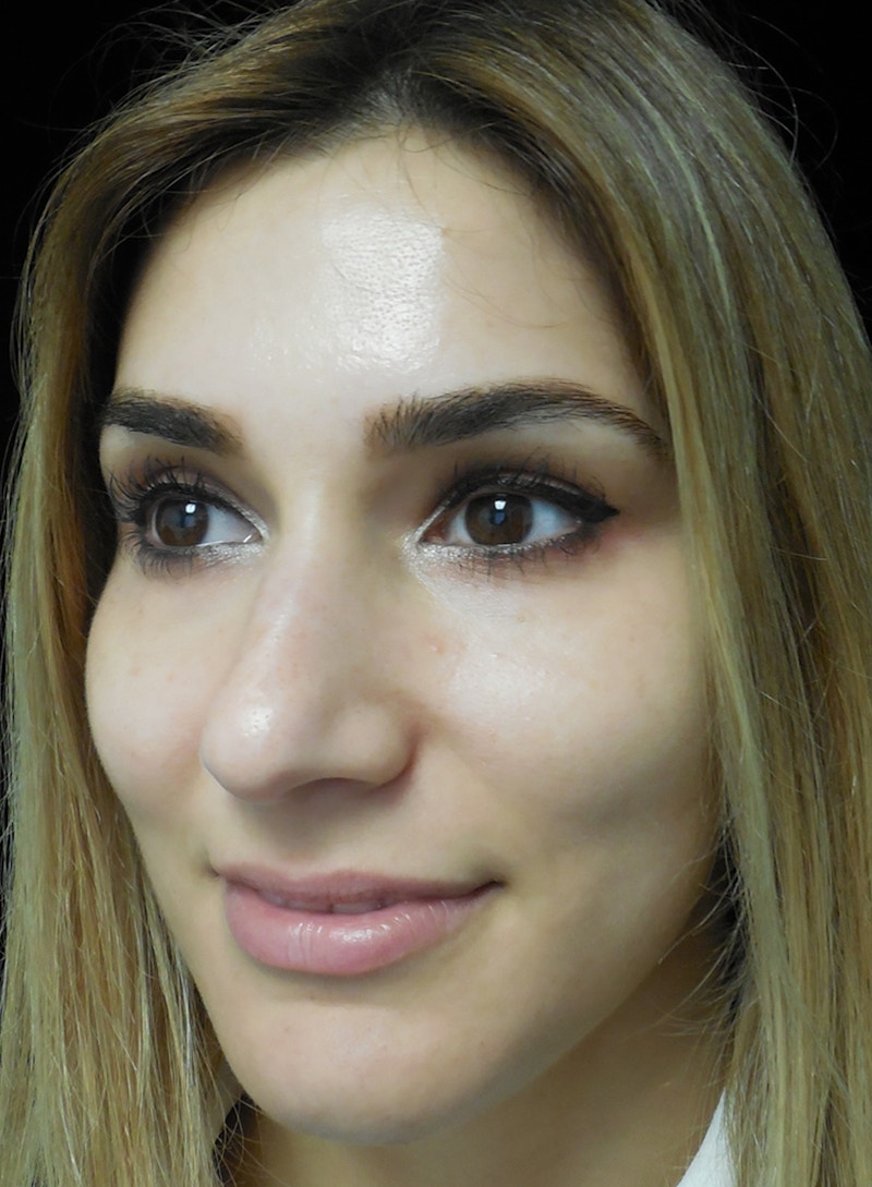 Beverly Hills Rhinoplasty Before & After Gallery - Patient 121795 - Image 3 Dr. Deepak Raj Dugar
