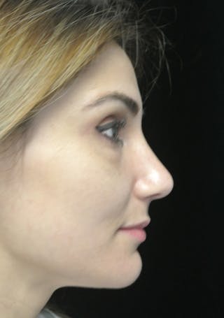 Beverly Hills Rhinoplasty Before & After Gallery - Patient 121795 - Image 2 Dr. Deepak Raj Dugar