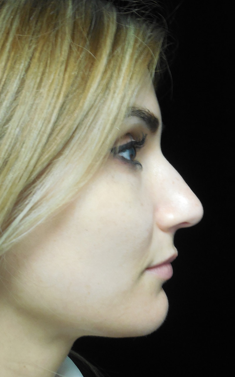 Beverly Hills Rhinoplasty Before & After Gallery - Patient 121795 - Image 1 Dr. Deepak Raj Dugar