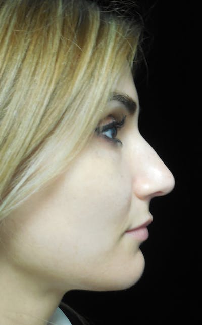 Beverly Hills Rhinoplasty Before & After Gallery - Patient 121795 - Image 1 Dr. Deepak Raj Dugar