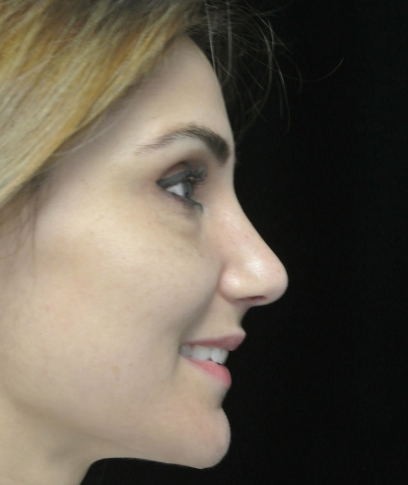Beverly Hills Rhinoplasty Before & After Gallery - Patient 121795 - Image 6 Dr. Deepak Raj Dugar