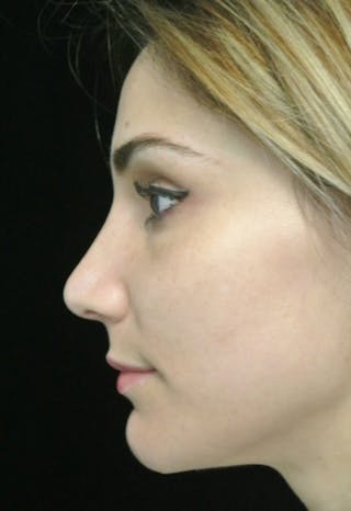 Beverly Hills Rhinoplasty Before & After Gallery - Patient 121795 - Image 8 Dr. Deepak Raj Dugar