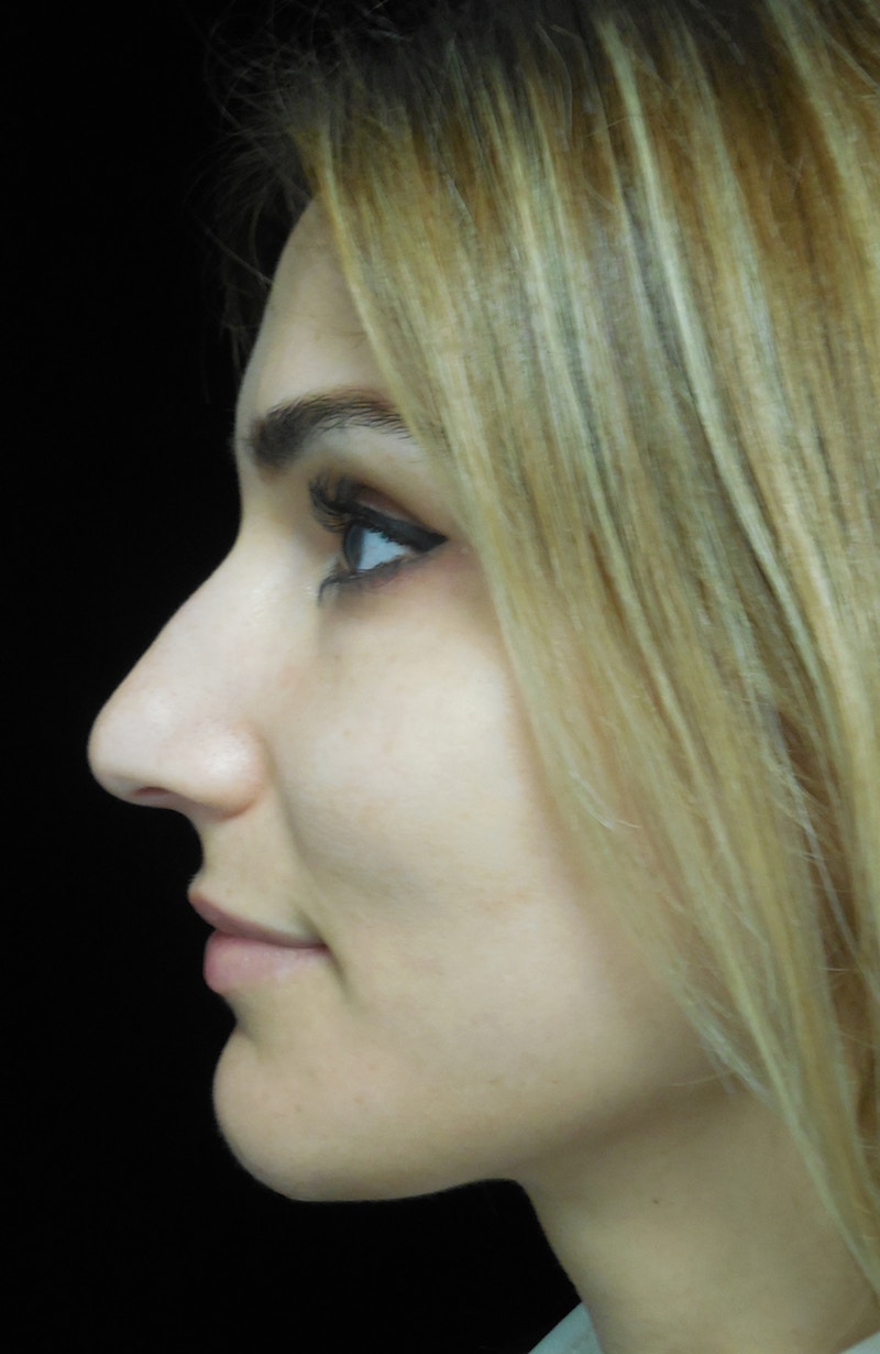 Beverly Hills Rhinoplasty Before & After Gallery - Patient 121795 - Image 7 Dr. Deepak Raj Dugar