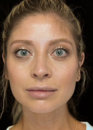 Beverly Hills Rhinoplasty Before & After Gallery - Patient 210247 - Image 4 Dr. Deepak Raj Dugar