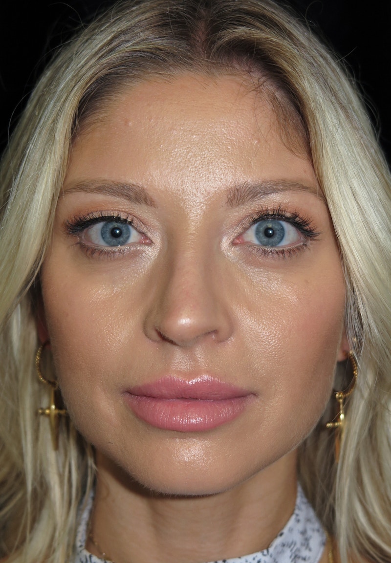 Beverly Hills Rhinoplasty Before & After Gallery - Patient 210247 - Image 3 Dr. Deepak Raj Dugar
