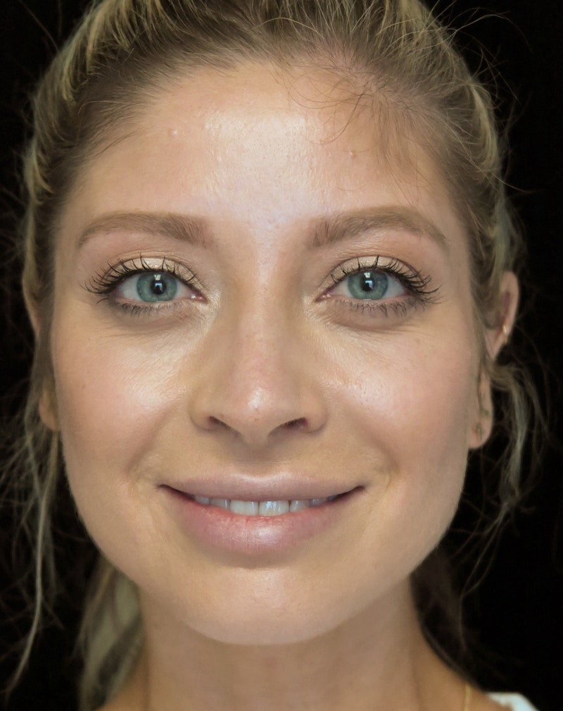 Beverly Hills Rhinoplasty Before & After Gallery - Patient 210247 - Image 6 Dr. Deepak Raj Dugar