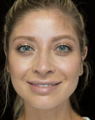 Beverly Hills Rhinoplasty Before & After Gallery - Patient 210247 - Image 6 Dr. Deepak Raj Dugar