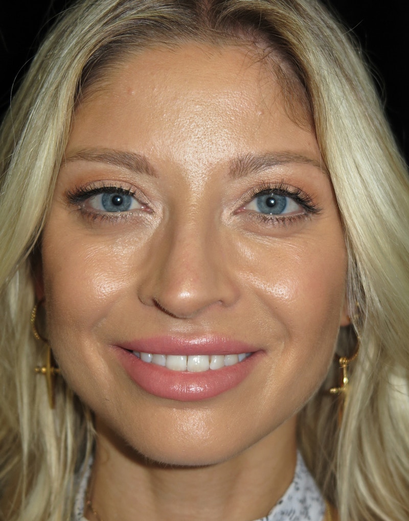 Beverly Hills Rhinoplasty Before & After Gallery - Patient 210247 - Image 5 Dr. Deepak Raj Dugar