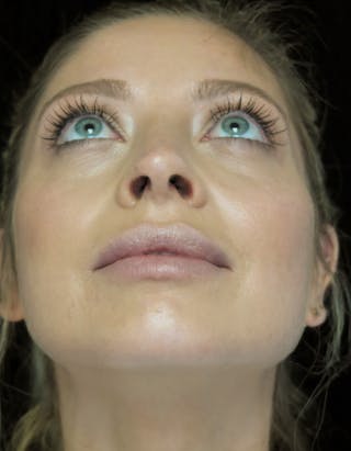 Beverly Hills Rhinoplasty Before & After Gallery - Patient 210247 - Image 8 Dr. Deepak Raj Dugar