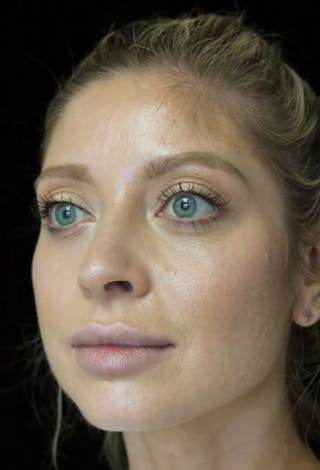 Beverly Hills Rhinoplasty Before & After Gallery - Patient 210247 - Image 10 Dr. Deepak Raj Dugar