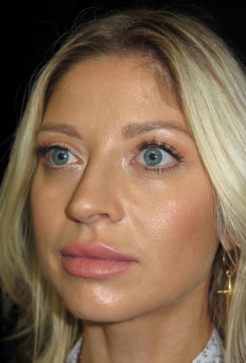 Beverly Hills Rhinoplasty Before & After Gallery - Patient 210247 - Image 9 Dr. Deepak Raj Dugar