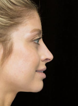 Beverly Hills Rhinoplasty Before & After Gallery - Patient 210247 - Image 2 Dr. Deepak Raj Dugar