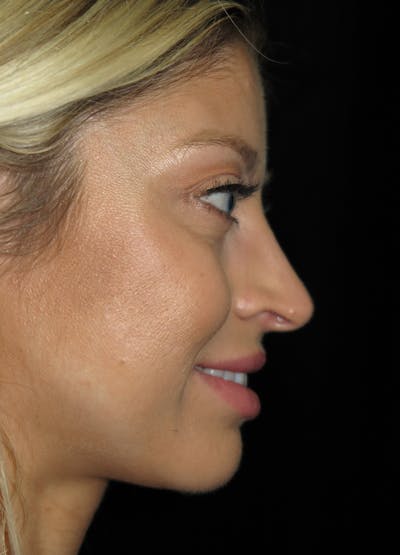 Beverly Hills Rhinoplasty Before & After Gallery - Patient 210247 - Image 1 Dr. Deepak Raj Dugar