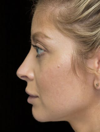 Beverly Hills Rhinoplasty Before & After Gallery - Patient 210247 - Image 12 Dr. Deepak Raj Dugar