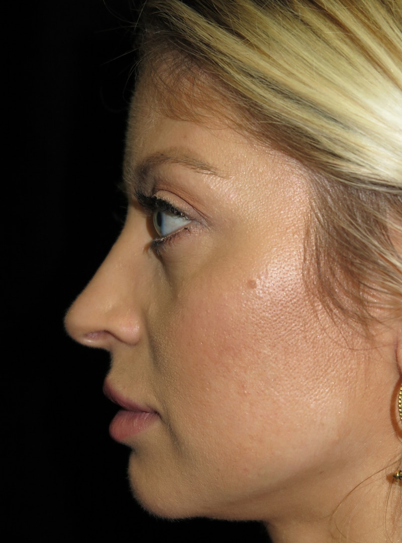 Beverly Hills Rhinoplasty Before & After Gallery - Patient 210247 - Image 11 Dr. Deepak Raj Dugar