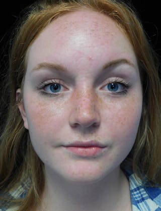 Beverly Hills Rhinoplasty Before & After Gallery - Patient 504445 - Image 4 Dr. Deepak Raj Dugar